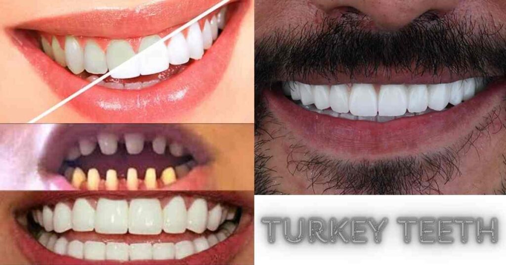 Turkey Teeth