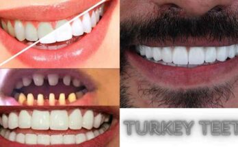 Turkey Teeth